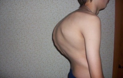 Hiperkyphosishoz háti gerinc, mi ez, tünetek, kezelés