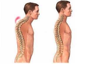 Hiperkyphosishoz háti gerinc tünetek és a kezelés mértékét