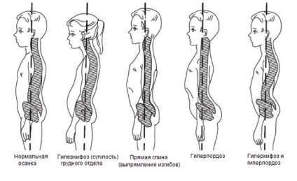 Hiperkyphosishoz háti gerinc tünetek és a kezelés mértékét