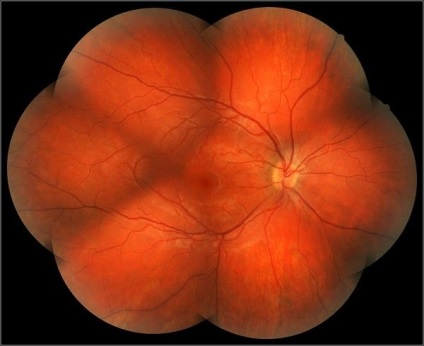 Ahogy fényképezett szemfenék (például fényképezett fundus) Hogyan lehet fényképezni a szemfenék
