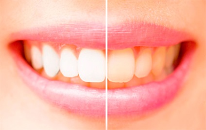 Hogyan fehéríti a fogakat verseny