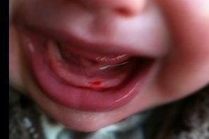 Honnan tudod, hogy a baba fogzási tünetek megjelenése fogak, fotók a folyamat lépések
