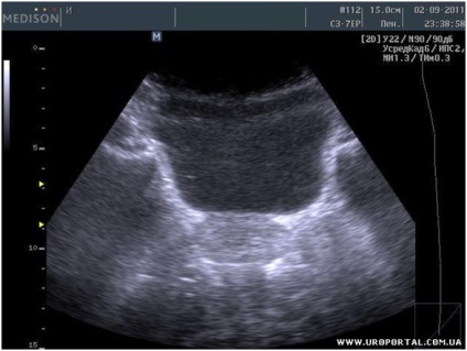 prosztata ultrahang vizsgálat