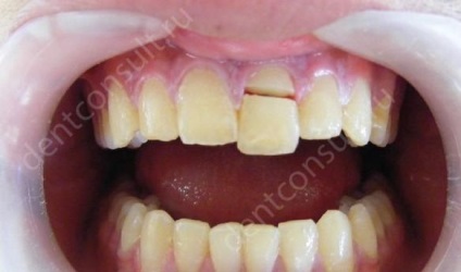 Osztályozás formái és típusai a periodontális betegség (periodontitisz előfordulása infiltráció) Osztályozása formája és típusa a fogágy