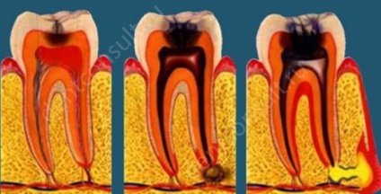 Osztályozása formái és típusai a periodontális betegség (periodontitisz megtekintés) Osztályozása formája és típusa a fogágy