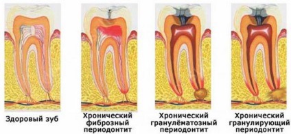 Osztályozása formái és típusai a periodontális betegség (periodontitisz) Osztályozása formája és típusa a fogágy