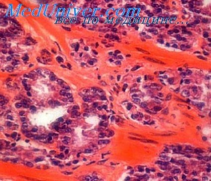Clinic adenoma a prosztata (prosztata adenoma klinika) Clinic prosztata adenoma