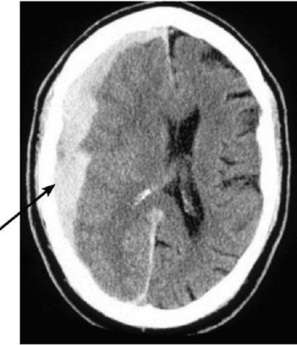 CT (komputertomográfia) agyban, amely megmutatja, CT angiográfia