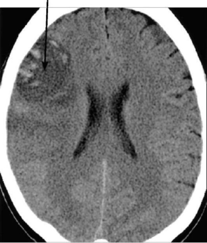 CT (komputertomográfia) agyban, amely megmutatja, CT angiográfia