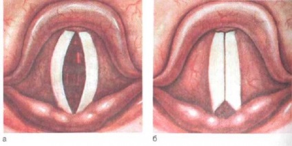 Laryngitis csecsemők vagy újszülött okai, tünetei, kezelése és megelőzése