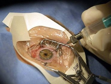 Lézeres szemműtét technikák, értékbecslés, kockázati