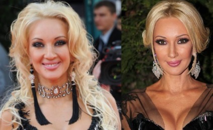 Lera Kudryavtseva képek előtt és után műanyag - 300 (utána) Lera Kudryavtseva képek előtt és után műanyag - 300