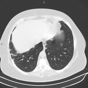 Lymphoma, tüdő tünetei, prognózis, okait, az osztályozás, diagnózis és kezelés