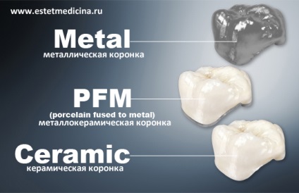 Cermet vagy kerámia koronák vélemények, árak, online magazin (kerámia fogászati vélemény) Cermet vagy kerámia koronák vélemények, árak, online magazin