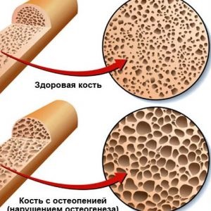 Van gyógymód osteopenia