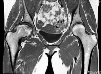 hip MRI, amely megmutatja, hogyan kell elkészíteni és