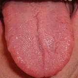Nyelvet bevonat diagnosztizálni betegség - orvosához Aibolit (utána) Nyelvet bevonat diagnosztizálni betegség - kezelőorvosát Aibolit