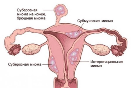 Név gyertyát méh mióma (név) Név gyertyát méhfibrómák