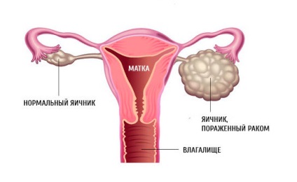 A rosszul differenciált adenocarcinoma - tünetek, kezelés, prognózis (Outlook) A rosszul differenciált adenocarcinoma - tünetek, kezelés, prognózis