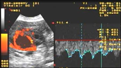 Normál ultrahang anatómiájának és fiziológiájának a méh és a petefészkek ultrahangos diagnosztika