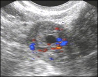 Normál ultrahang anatómiájának és fiziológiájának a méh és a petefészkek ultrahangos diagnosztika