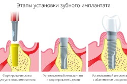 Szövődményei fogászati ​​implantátumok