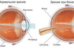 A különbség a rövidlátás és távollátás (myopia) A különbség a távollátás és a myopia