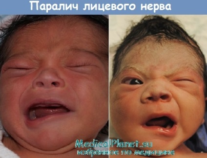 Arcideg bénulás újszülöttek - klinikai kép, diagnózis, kezelés