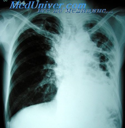 Patogenetikai tuberculosis terápia (terápia) Kóroki tuberkulózis terápia