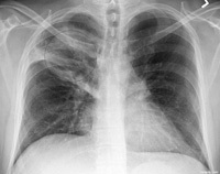Kóroki betegek kezelésére tuberkulózis