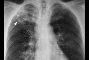A tüdőgyulladás és a tuberkulózis röntgen másképp néz ki, megrendelést lótücsökfélék