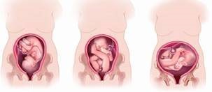 Elhelyezkedés és bemutatása a magzat a terhesség alatt a kismedencei, fej, kereszt, ...