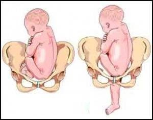 Elhelyezkedés és bemutatása a magzat a terhesség alatt a kismedencei, fej, kereszt, ...