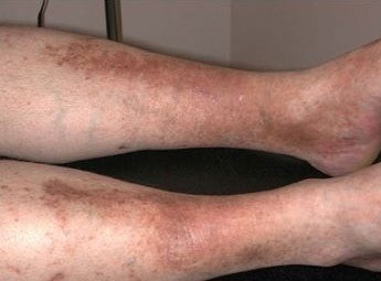 Következmények és komplikációk zsírleszívás után mellékhatásokat és kárt (utána) Következmények és szövődmények zsírleszívás után a mellékhatások és károk