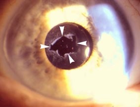 Előnyei Laser Eye Mikrosebészeti - a műveletek típusa, a lézer a szemészetben