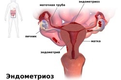 Az endometriózis tünetei a Uzi