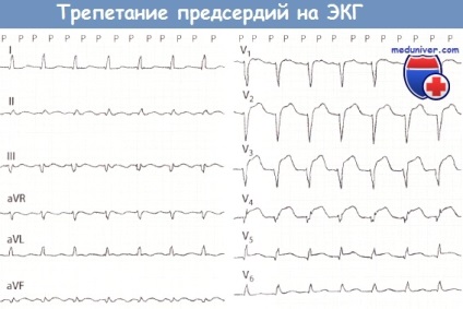A tünetek a pitvarfibrilláció az EKG (flutter) Tünetei pitvarfibrilláció az EKG