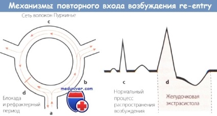 A tünetek a pitvarfibrilláció az EKG (pitvar) Tünetei pitvarfibrilláció az EKG