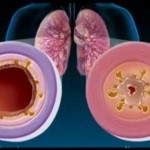 Megelőzése bronchitis, hogyan lehet elkerülni a betegséget, gyógyszerek