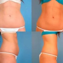 Photo cryolipolysis eljárás, ellenjavallatok