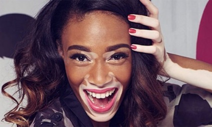 Mintegy Vitiligo - minden vitiligo (vitiligo) Mintegy Vitiligo - minden vitiligo