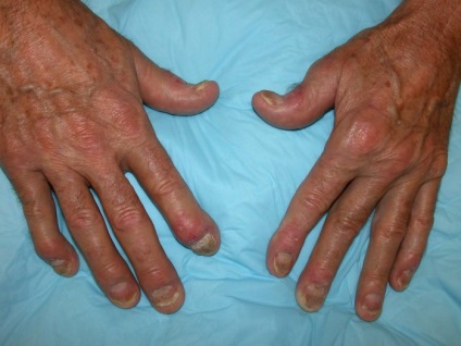 Psoriatica eritrodemiya képek (szoptató anya beteg) A pszoriázisos eritrodemiya fotó