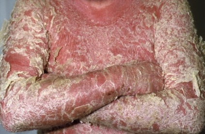 Psoriatica eritrodemiya képek (terhes szoptatós anyák beteg) A pszoriázisos eritrodemiya fotó
