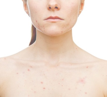 Psoriatica eritrodemiya képek (pikkelysömörös) A pszoriázisos eritrodemiya fotó