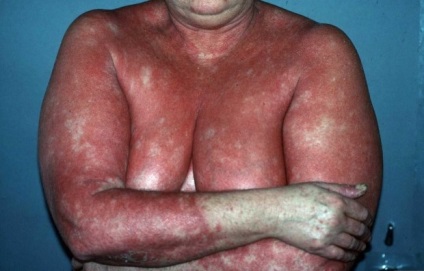 Psoriatica eritrodemiya képek (szoptató anya beteg) A pszoriázisos eritrodemiya fotó