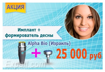 Fajták tömítések állandó, ideiglenes, cement, fotopolimer (fotopolimer) Faj tömítések állandó, ideiglenes, cement, fotopolimer