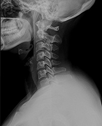 X-ray a gerinc