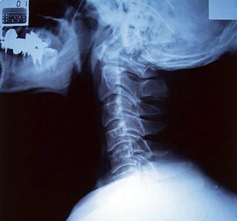 X-sugarak a nyaki gerinc javallatok és ellenjavallatok
