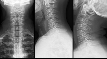 X-sugarak a gerincoszlop nyaki részének funkcionális vizsgálatok radiográfiai folyamat