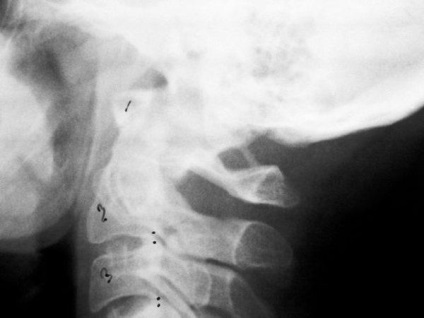 X-sugarak a gerincoszlop nyaki részének funkcionális vizsgálatok radiográfiai folyamat